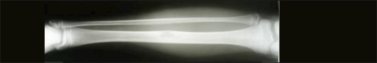 healthkey_content_tumoren_bewegungsapparat_spotlight.png